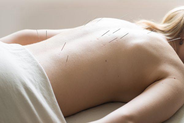 Acupuncture: the art of fine needles