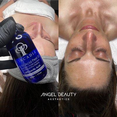 Chemical Peel no downtime!  Lactic Gel base peels are designed to deliver hydration, inhibit melanin production.