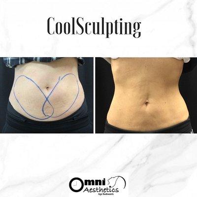 CoolSculpting before and after results. A non-surgical procedure with little to no downtime!