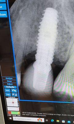 Tooth implant after 1 year