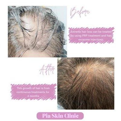 Hair Loss Treatment