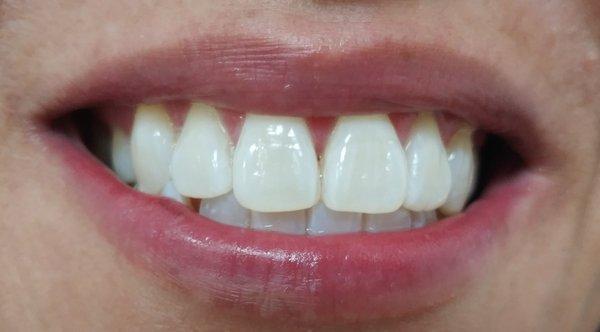 Our lovely patient after her Zoom Whitening