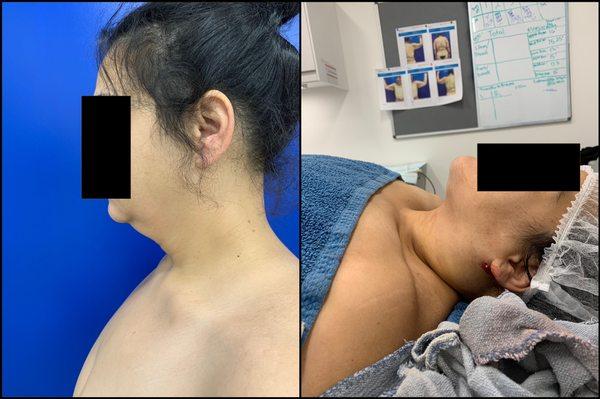 Look at the immediate results after chin and neck liposuction.