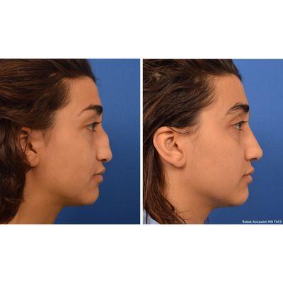 Best rhinoplasty results in Beverly Hills