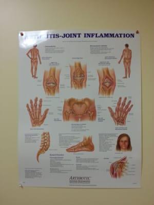 Arthritis-Joint Inflammation Graph