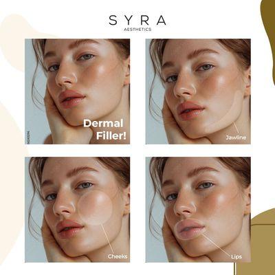 Get the look you crave--sculpted jawline, defined cheeks, or luscious lips--with Dermal Filler!