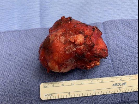 Tumor that was removed from my head by dr Capo and dr DeBLASI. Both EXCELLENT DOCTORS! Successful surgery. God bless them and their staff.