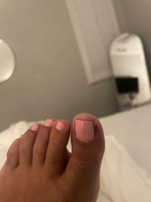 Toe injury from electric file. Monitoring for infection