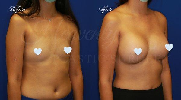 Breast Augmentation - 385cc High Profile, Gummy Bear Implants