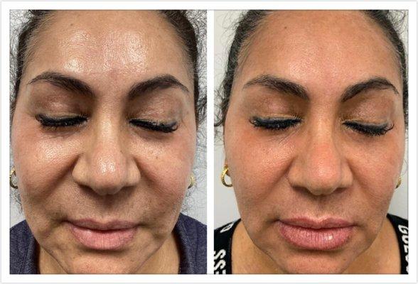 Laser and Lip Filler Treatment