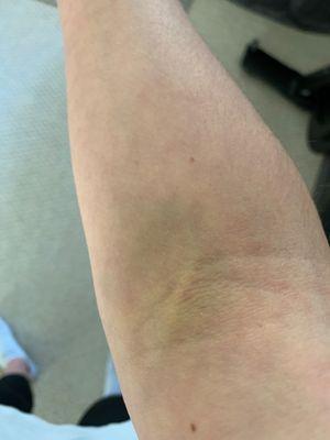 4 day post blood test bruise