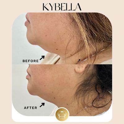 Kybella fat dissolving injection before and after