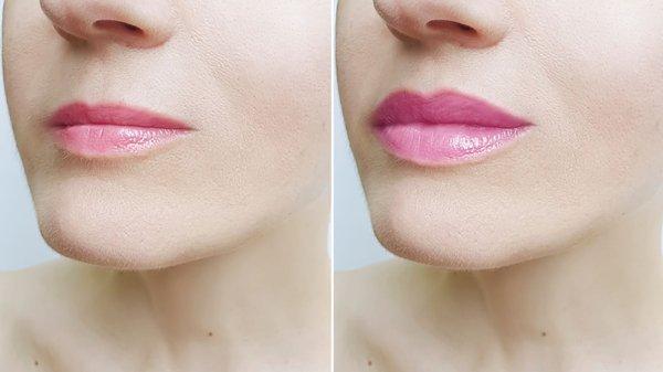 Lip Enhancement - Our lip enhancement services are designed to leave your lips fuller and more voluminous than ever before.