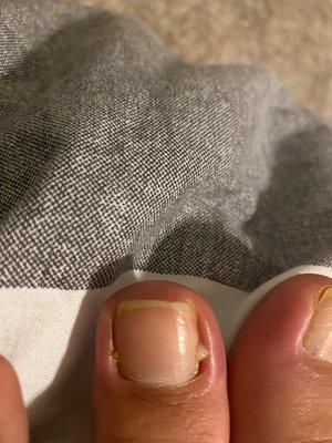 Infected toe