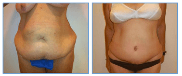 Abdominoplasty