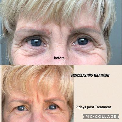 Before and after Fibroblasting Treatment