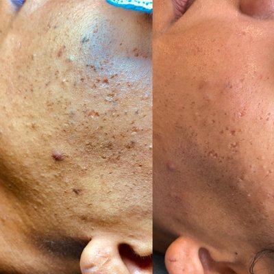 Acne Facial same day treatment