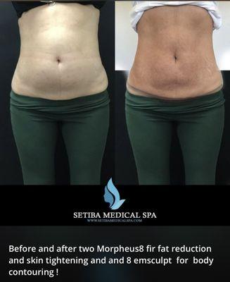 Before and after non-surgical Morpheus8 skin tightening and fat reduction plus Emsculp