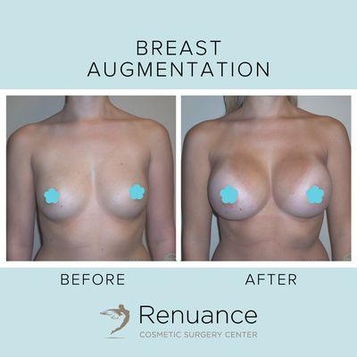 Breast Augmentation at Renuance Cosmetic Surgery Center & Medical Spa in Murrieta, CA