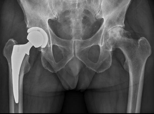 Anterior Hip Replacement