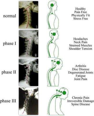 Good posture less pain