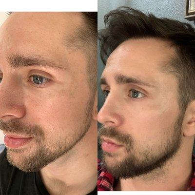 Skincare results