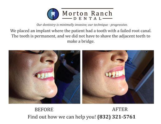 Need an implant? We have an implant special going on. $2100 for the implant, crown, and abutment.