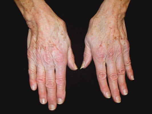 hand veins after treatment