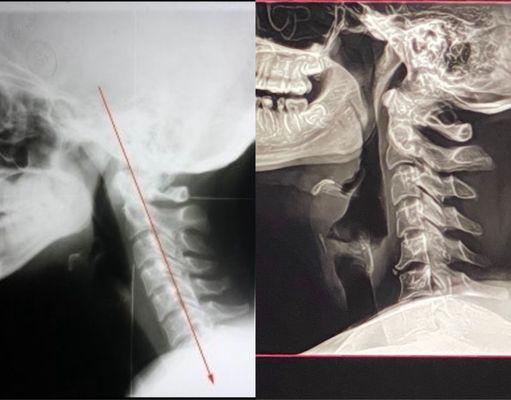 X-ray results before and after, after major correction.