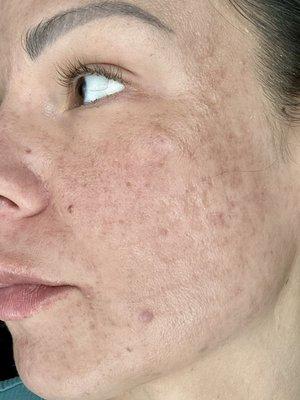 Hyperpigmentation following procedure