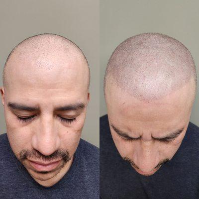 Scalp Micropigmentation