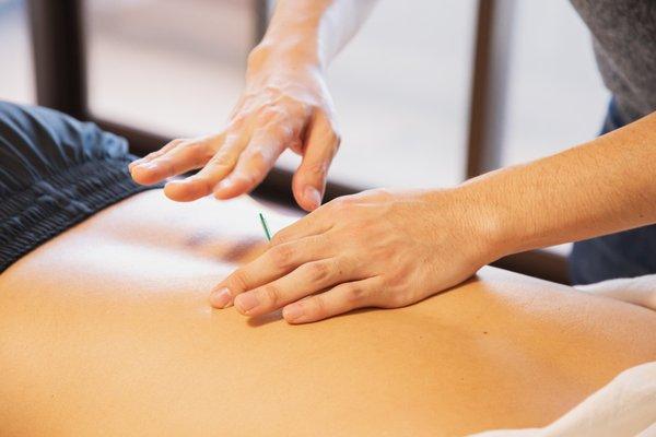 Acupuncture Treatment