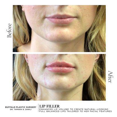 lip filler