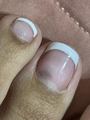 Nail fungus