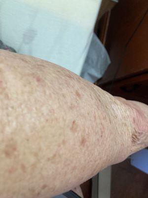 They are pictures of my arms and legs with the Scabies and what they did to me.