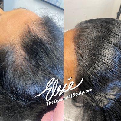 Thicker fuller hairline by Elsie