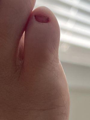 toe nail fell completely off