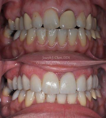 Cosmetic rehab for a patient presenting with old, discolored,  poorly matching crowns.