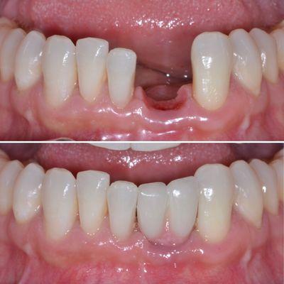 Tooth replacement with a dental Implant