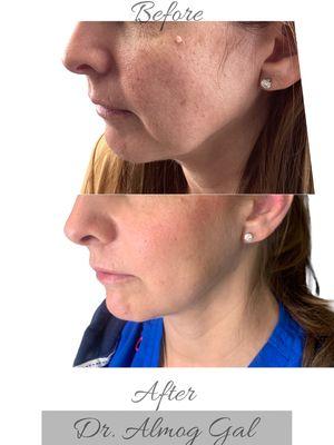 Our client ..Want to get rid of those sagging cheeks Visit Dr Gal  for our Non Evasive facelift