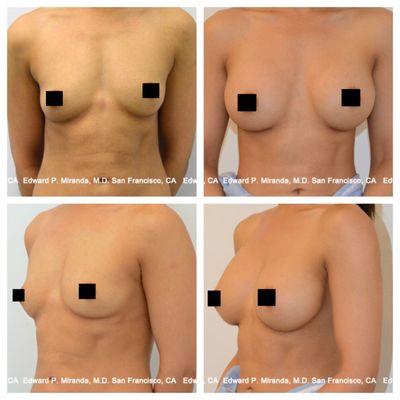 Breast Augmentation Before and After Photos