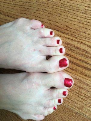 Bad pedicure