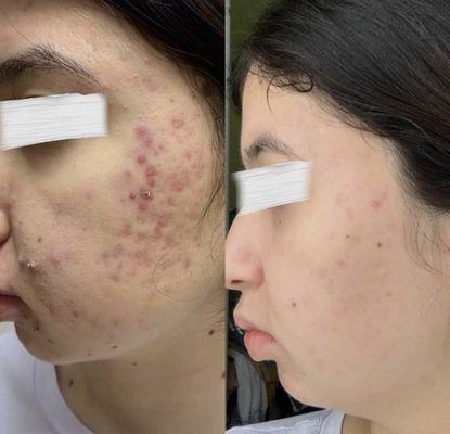 Acne treatment with PlaSon Plasmaporation