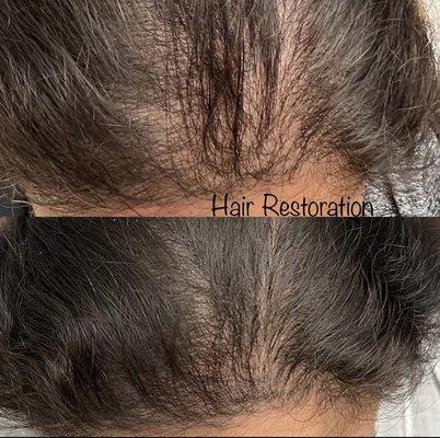 Best Hair Restoration Medical Spa in Issaquah, Washington