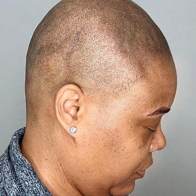 Scalp Micropigmentation for soft temple and hairline work.