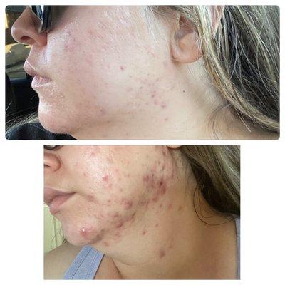 2.5 months treated by dermatologist (bottom) vs. 2.5 months with Hilda (top)