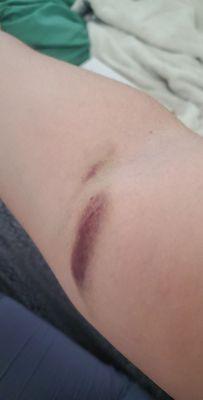 I've never had bruising like this before!