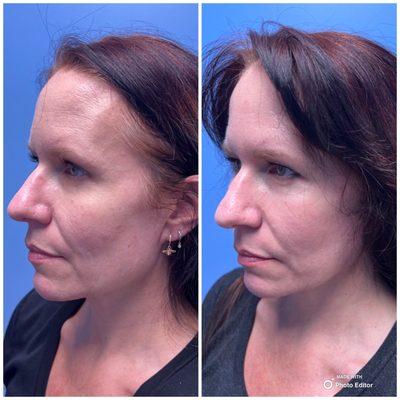 Left is PRE-surgery for deep plane facelift and neck lift. Right is 1-year POST surgery. No difference.