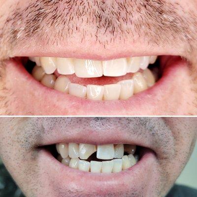 We restored our patient's beautiful smile with implants and crowns.