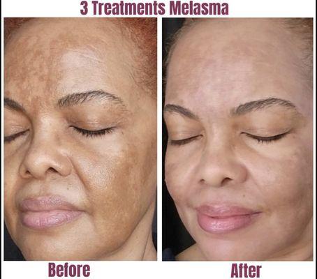 Melasma can be a big problem for many, but not anymore!! 3 comfortable treatments and her condition reduced!!